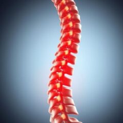 Skolioza: Przyczyny, rodzaje, diagnostyka i metody leczenia