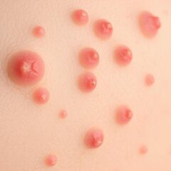 Rogowacenie okołomieszkowe: przyczyny, objawy i leczenie